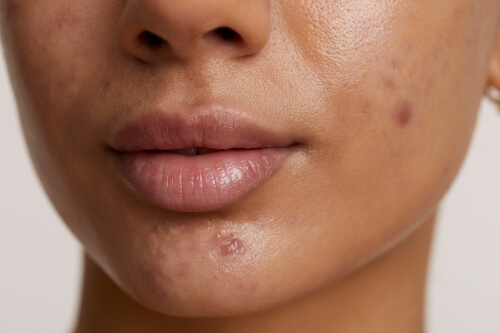 Pielęgnacja skóry w trakcie leczenia dermatologicznego - krok po kroku