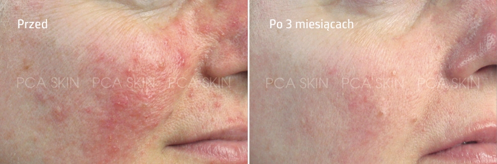 PCA Skin - Sensi Peel