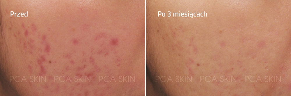 PCA Skin - Sensi Peel