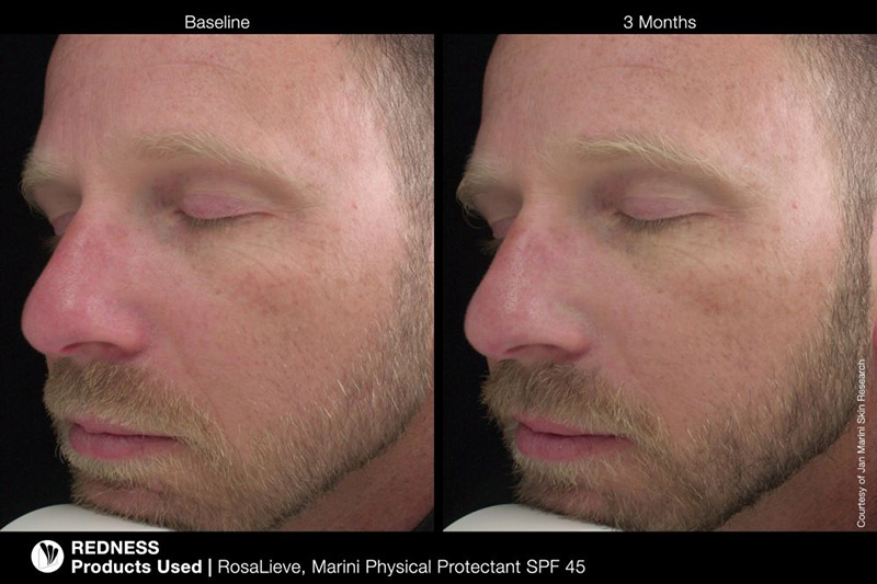 Jan Marini RosaLieve + Marini Physical Protectant Untinted SPF 30 + Kosmetyczka ZESTAW Lotion redukujący zaczerwienienia 30 ml + Krem ochronny 57 g