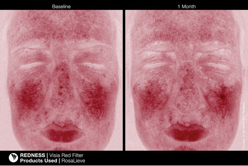 Jan Marini RosaLieve + Marini Physical Protectant Untinted SPF 30 + Kosmetyczka ZESTAW Lotion redukujący zaczerwienienia 30 ml + Krem ochronny 57 g