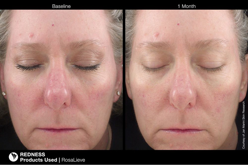 Jan Marini RosaLieve + Marini Physical Protectant Untinted SPF 30 + Kosmetyczka ZESTAW Lotion redukujący zaczerwienienia 30 ml + Krem ochronny 57 g