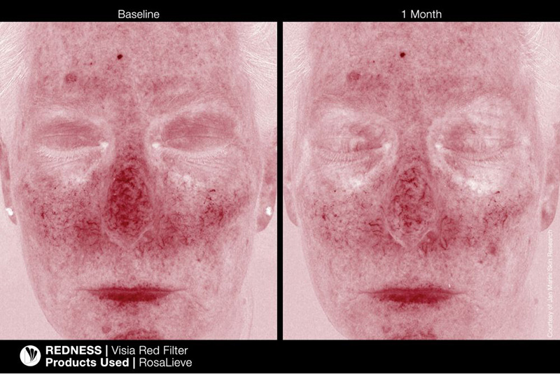 Jan Marini RosaLieve + Marini Physical Protectant Untinted SPF 30 + Kosmetyczka ZESTAW Lotion redukujący zaczerwienienia 30 ml + Krem ochronny 57 g